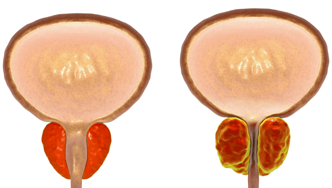 Co to jest zapalenie prostaty