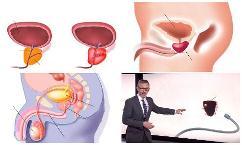 zdrowa i chora prostata